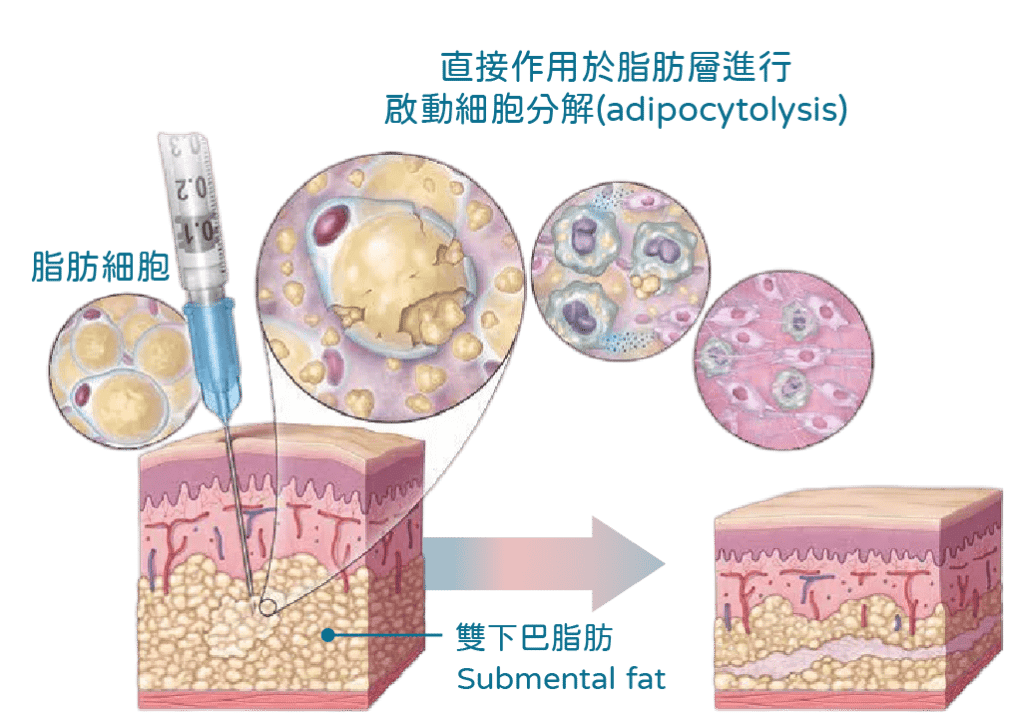 BELKYRA 溶脂機制示意：注射入頦下脂肪 → 破壞脂肪細胞 → 身體自然清除