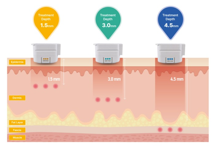 Ultherapy® 1.5mm / 3.0mm / 4.5mm 三種治療深度示意圖